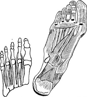 Line drawing of a left foot with cramped toes, and half a left foot with toe bones that are aligned with metatarsal bones.